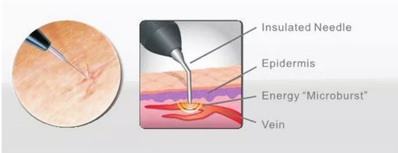 सौंदर्य सैलून दर्द निवारण/संवहनी उपचार के लिए 980nm डायोड लेजर मशीन