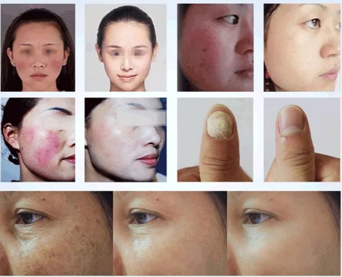 सौंदर्य सैलून दर्द निवारण/संवहनी उपचार के लिए 980nm डायोड लेजर मशीन