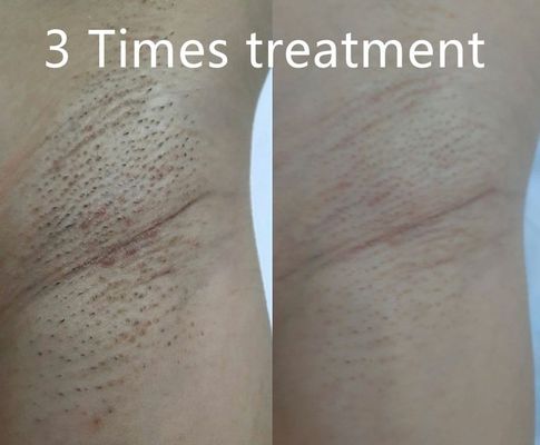 विभिन्न स्थायी बाल कमी के लिए विभिन्न पल्स चौड़ाई का समर्थन करने वाला मल्टी फंक्शनल डायोड लेजर हेयर रिमूवल डिवाइस